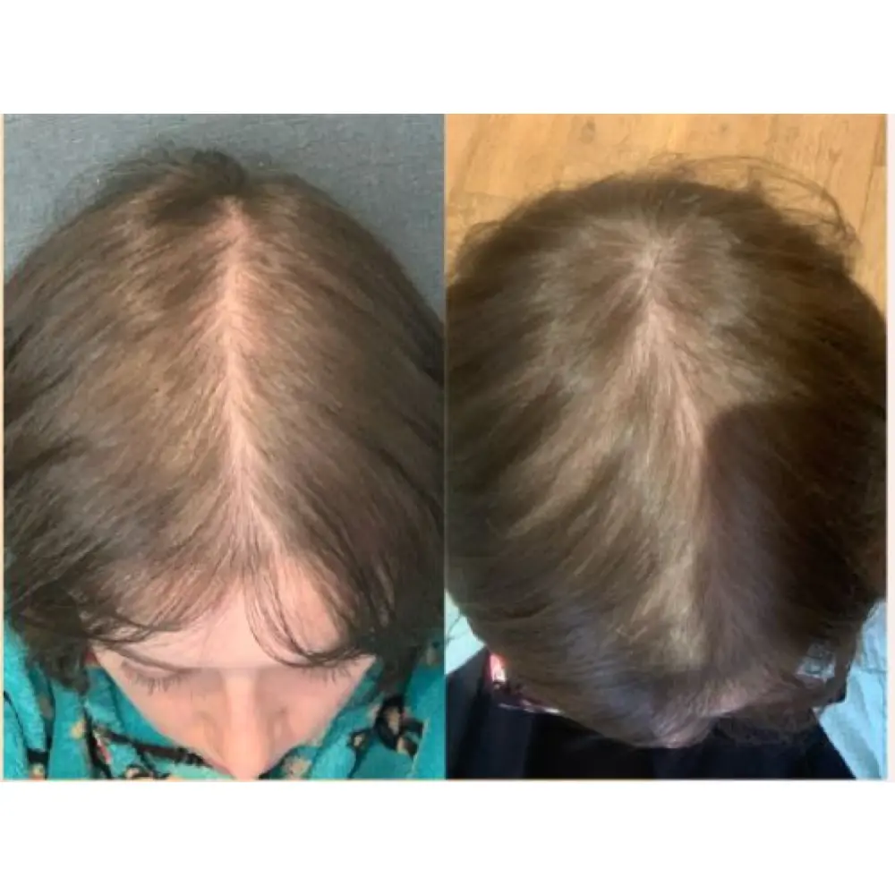 Multidose Hairlift + foto hoofd met haar